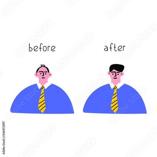 Hair transplant. Before after concept.  Hand drawn vector illustration on white background.