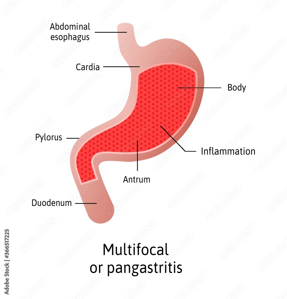 Location of Gastritis, multifocal, an inflammation of the lining of the