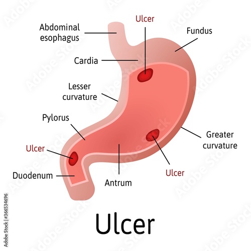 Peptic ulcer of the stomach, microscopic colorful anatomy on a white background. Medical vector illustration with all internal parts are marked with lines.