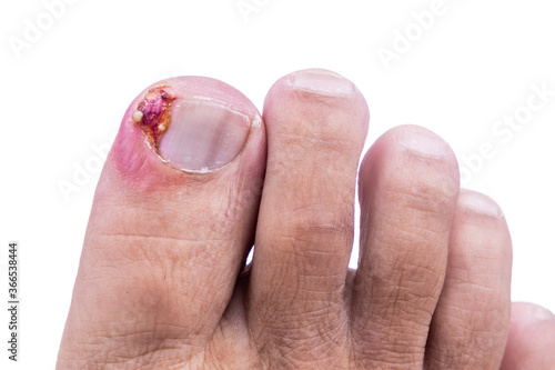 фотографія Closeup of inflammation and blood associated with ingrown toenail