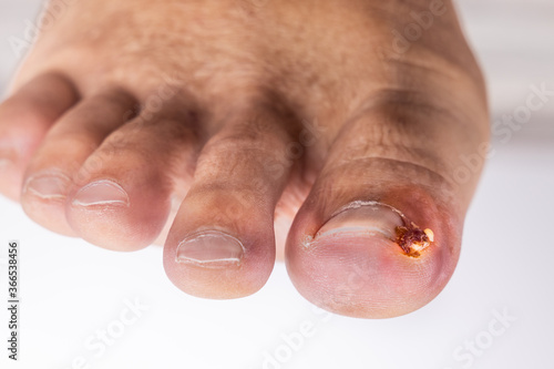 Fotografi Closeup of inflammation and blood associated with ingrown toenail