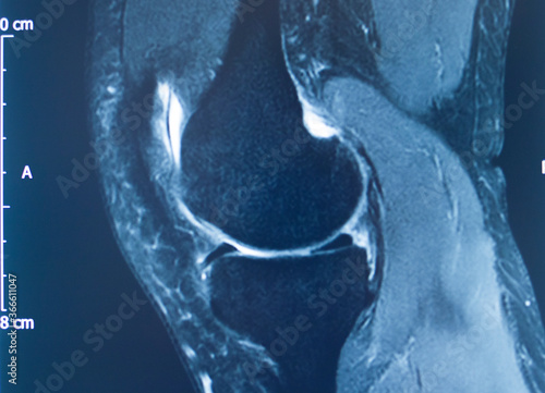 Canvas Print Knee injury mri mcl tear