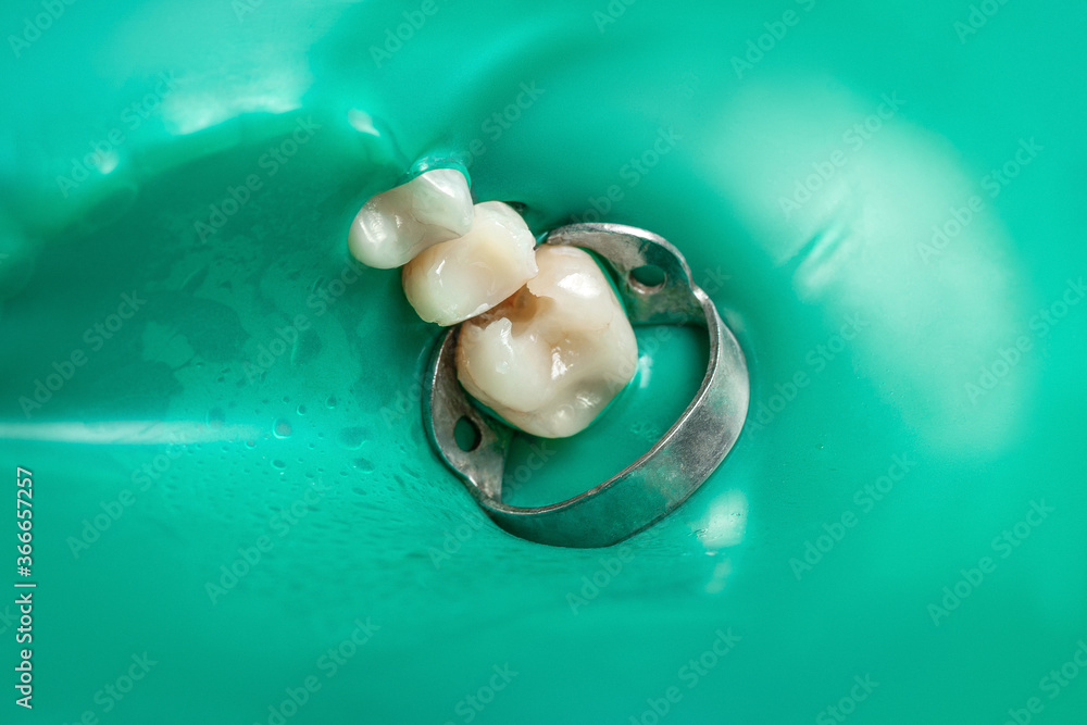 Dentistry, caries treatment. Oral cavity with rubber dam and claimer