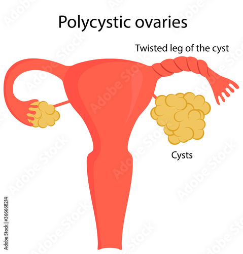 Twisted leg of the cyst
