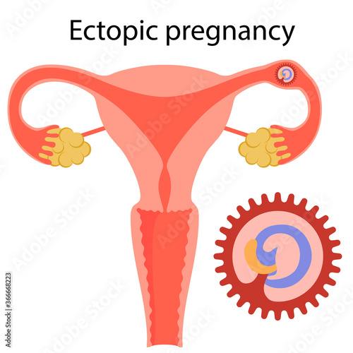Ectopic pregnancy. Complication.
