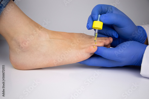 The doctor dermatologist drops the medicine with a pipette on the nail affected by the fungus. Antimycotic therapy. Treatment of candidiasis and assistance to patients with fungal diseases.