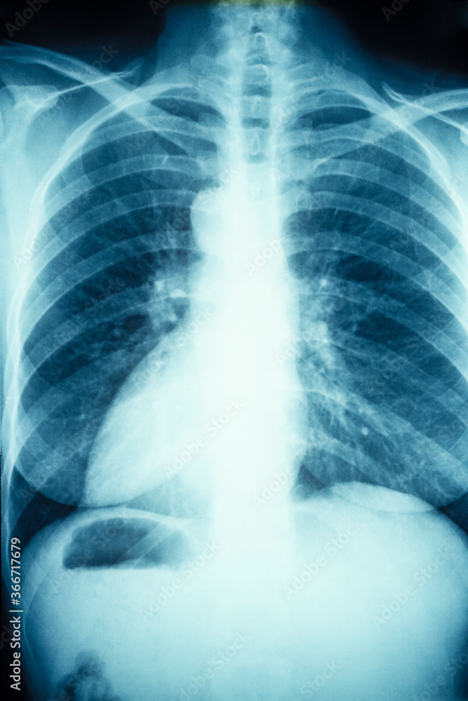 Chest x-ray.. Stock Photo | Adobe Stock