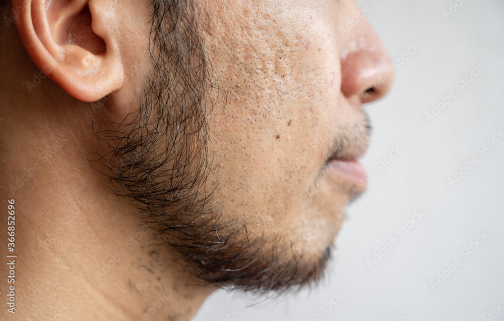 Side view of Asian man face with beard grows on a part of lower face. Beard