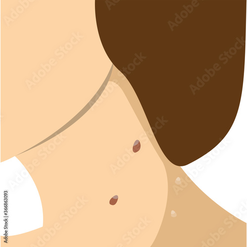 warts on neck flat vector