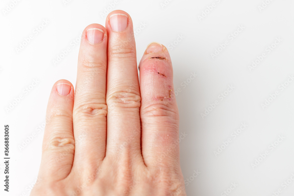 Foto Stock part of palm with cut index finger with a extensor tendon