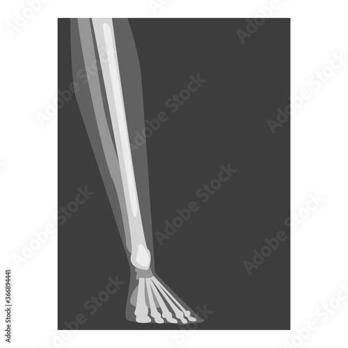 Roentgenograph of Lower Leg Front View Vector Image
