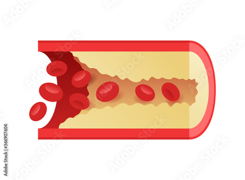 Coronary artery disease (CAD, CHD, IHD), ischemic illness that involves blood reduction flow to the heart muscle - isolated medical illustration