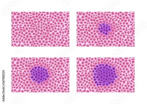 cancer and tumor cell stage and development vector .  malignant type on white background