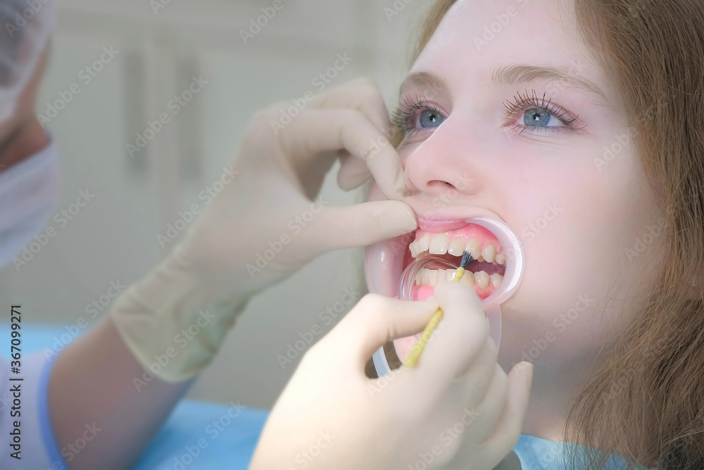 Orthodontist preparing woman teeth in dentistry before braces installing covering special gel using brush. Treatment and cure in dentistry. Portrait of girl with retractor in mouth. Correcting teeth. Orthodontist preparing woman teeth in dentistry before braces installing covering special gel using brush. Treatment and cure in dentistry. Portrait of girl with retractor in mouth. Correcting teeth.
