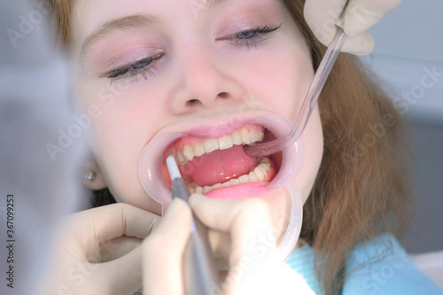 Patient young woman on hygienic cleaning of teeth procedure in dentistry by dentist. Doctor washes teeth water and nurse using saliva ejector. Oral hygiene and prophylactic cleaning, portrait closeup.