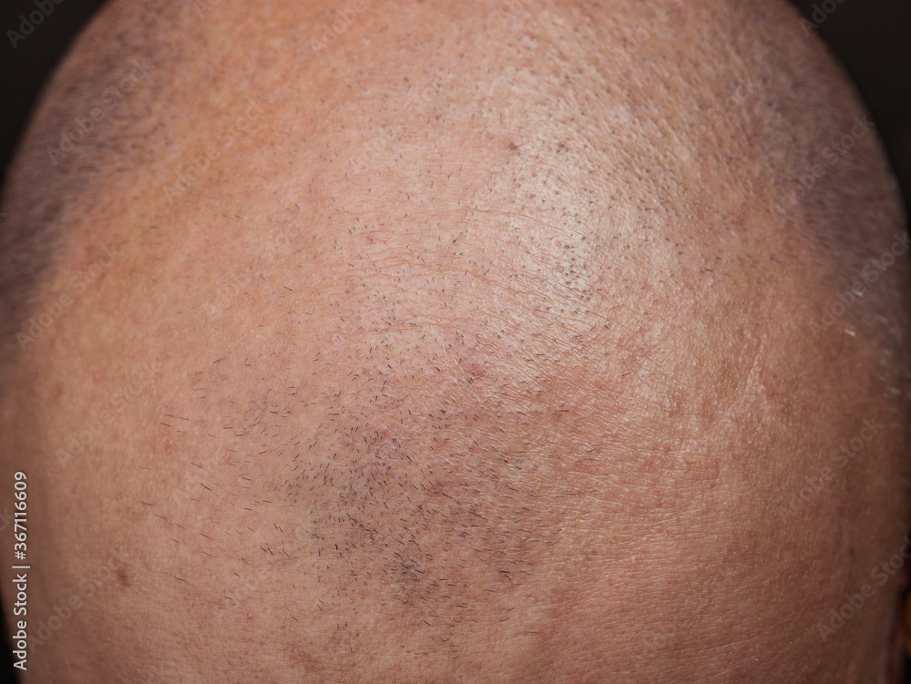 Human hair loss concept. Close up detail with a human head bald with alopecia.