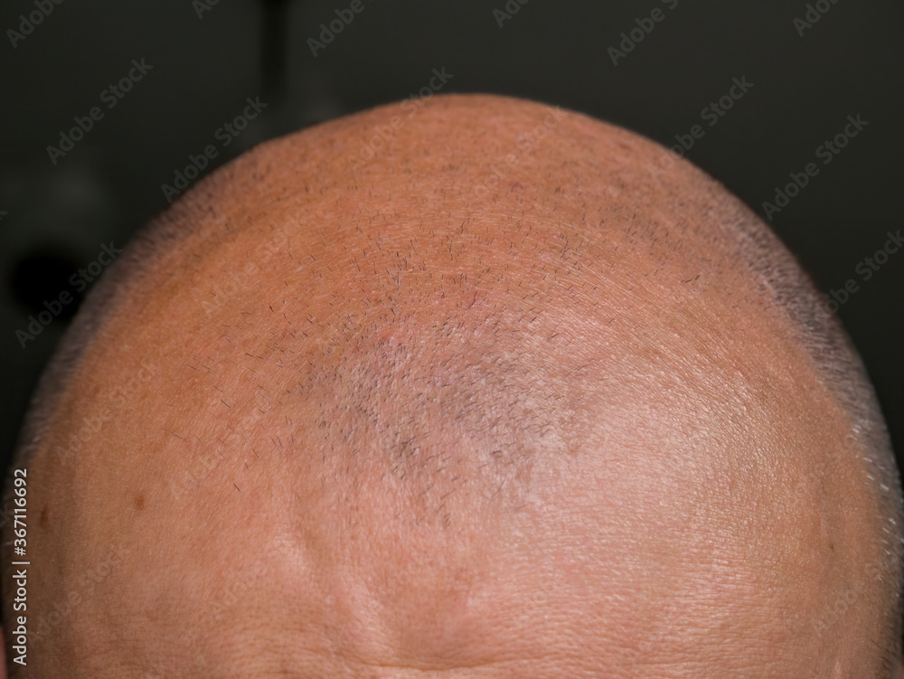 Fototapeta premium Human hair loss concept. Close up detail with a human head bald with alopecia.