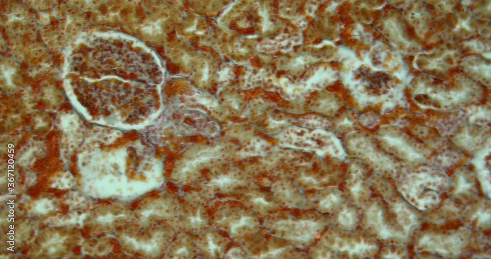 Jaundice in jaundice due to infection with hepatitis A under the