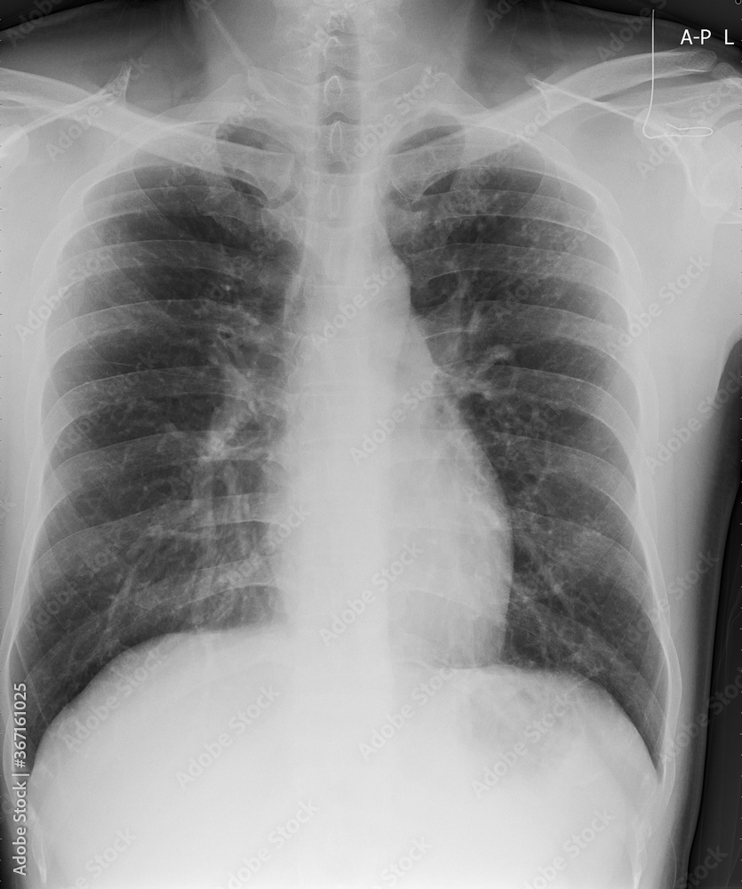 XRay body of The patient, XRay Image Of Human Chest for a medical diagnosis StockFoto Adobe