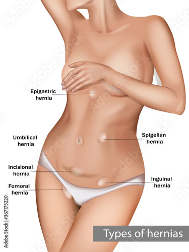 Types of abdominal hernias photo
