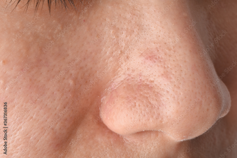 Greasy oily face and comedones, Skin problem with acne scar diseases, Close up woman face with blackhead pimples on nose. Greasy oily face and comedones, Skin problem with acne scar diseases, Close up woman face with blackhead pimples on nose.