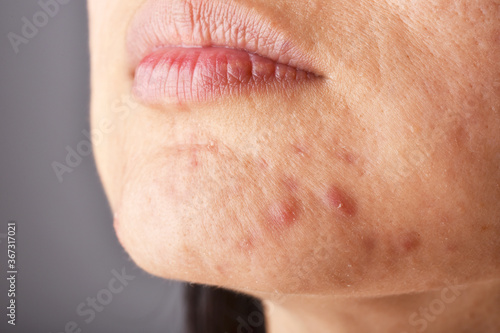 Obraz na płótnie Skin problem with acne diseases, Close up woman face with whitehead pimples on chin, Menstruation breakout, Scar and oily greasy face. w salonie