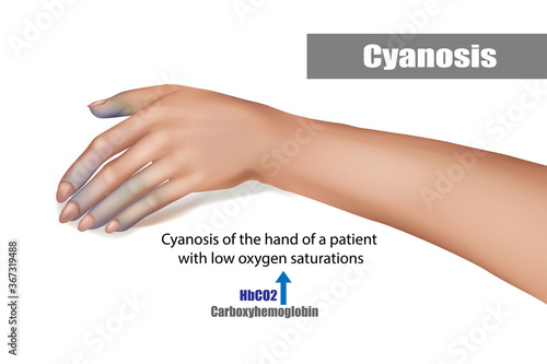 Cyanosis of the hand of a patient with low oxygen saturations photo
