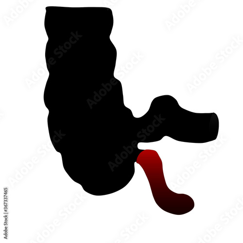 Vector illustration of Appendicitis. A medical term refer to Inflammation of the Appendix.