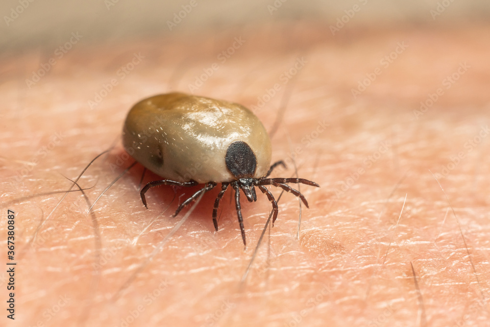 A tick drunk on blood crawls on human skin A tick drunk on blood crawls on human skin