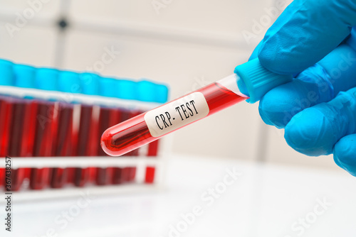 Blood sample test tube in doctor hand for C-reactive protein CRP test