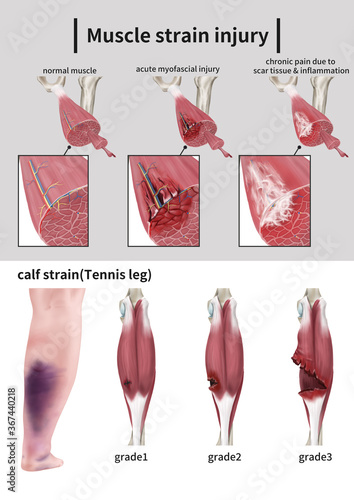  Medical illustration to explain muscle strain