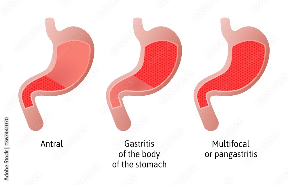 Location of Gastritis, an inflammation of the lining of the stomach. Three types Antral, of the body and pangastritis. Medical vector illustration marked with lines. All parts of stomach Location of Gastritis, an inflammation of the lining of the stomach. Three types Antral, of the body and pangastritis. Medical vector illustration marked with lines. All parts of stomach