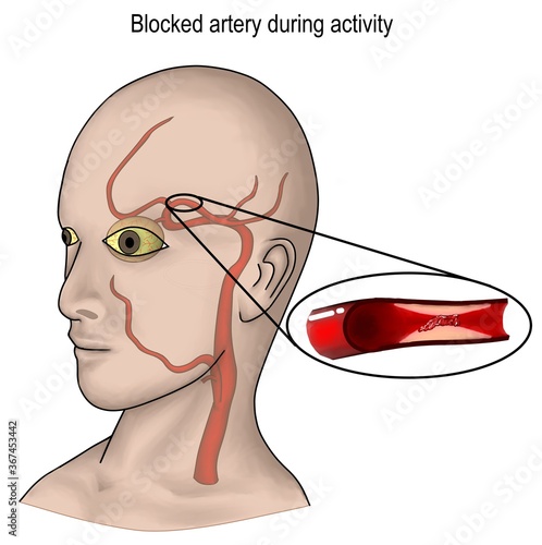 Fotografie the stroke onset with blocked artery occurs during the state of being fully alter