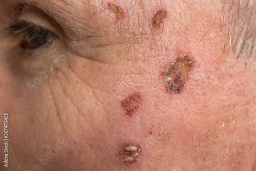 Tableau sur toile Wound from laser on a face from dermatologist