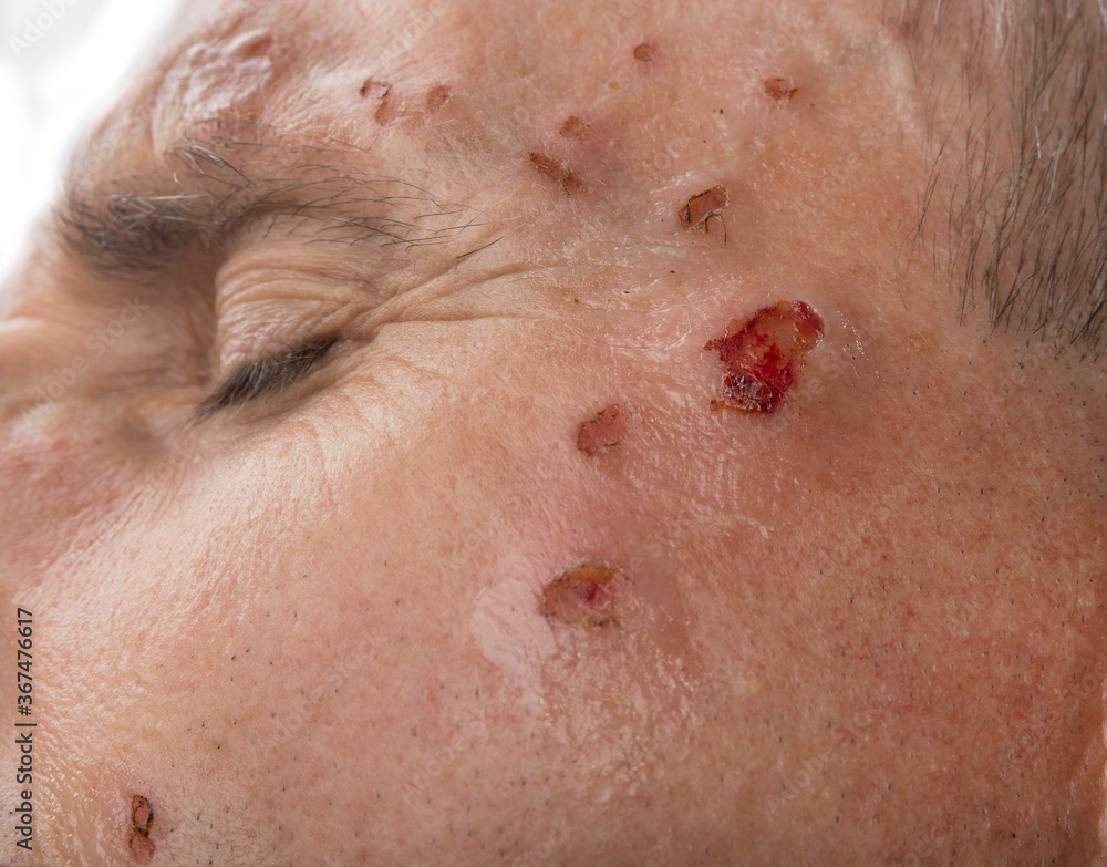 Wound from laser on a face from dermatologist Wound from laser on a face from dermatologist