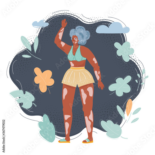 Cartoon illustration of young happy woman with vitiligo skin, pigmentation on arms and legs wearing swimsuit on dark background.