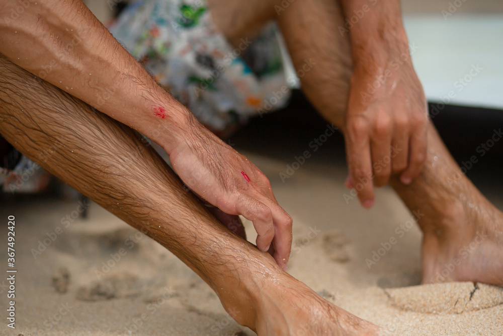 The guy got abrasions after an unsuccessful fall from the surf board. A wet guy on the shore examines an injured arm. The guy got abrasions after an unsuccessful fall from the surf board. A wet guy on the shore examines an injured arm.