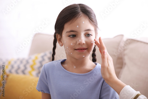 Mother applying cream onto skin of her daughter with chickenpox at home photo