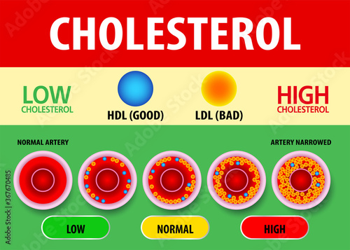 Cholesterol in artery, health risk , vector design