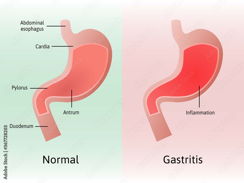 Gastritis, an inflammation, irritation, or erosion of the lining of the