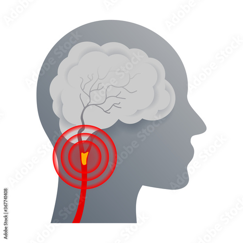 Cerebrovascular disease that affect the blood vessels of brain and cerebral circulation and damaged or deformed it - isolated vector icon