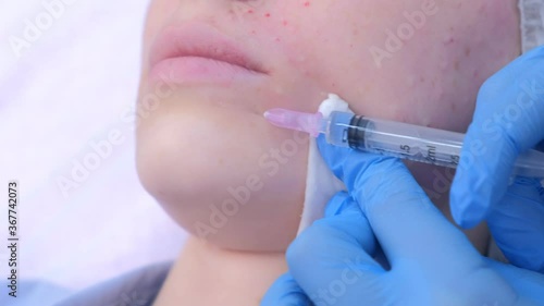 Cosmetologist doctor is making multiple injections biorevitalization with hyaluronic acid in woman face skin on chin under lips, closeup. Beautician on mesotherapy lifting procedure in beauty clinic.