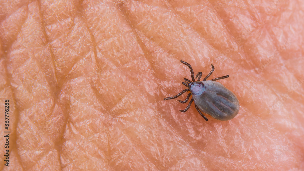 Small female deer tick on human skin texture. Ixodes ricinus or scapularis. Parasitic mite close-up. Fat body full of blood and visible hypostom piercing into epidermis. Encephalitis or Lyme disease. Small female deer tick on human skin texture. Ixodes ricinus or scapularis. Parasitic mite close-up. Fat body full of blood and visible hypostom piercing into epidermis. Encephalitis or Lyme disease.