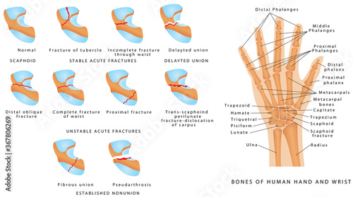 Wrist fracture (Scaphoid). Classification of scaphoid fractures. Break of the scaphoid bone in the wrist. Scaphoid bone fracture medical vector illustration on white background photo