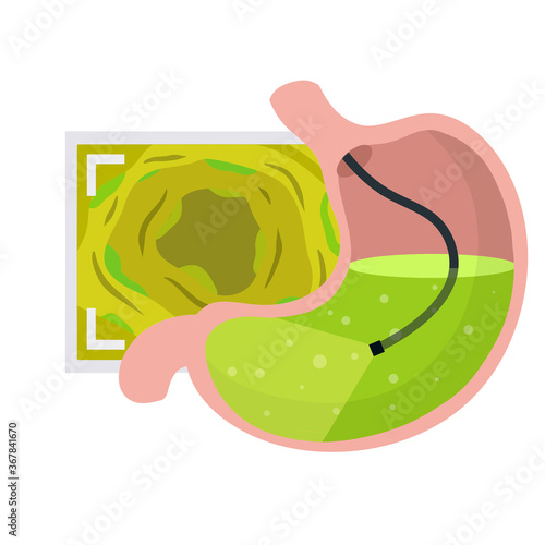 Gastroscopy. Endoscopy and digestive problems. Hose with camera. Procedure with internal organs. Cartoon flat illustration. Medical Visual inspection of stomach. Scan of monitor with screen