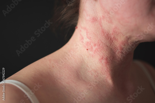 the girl has dermatitis on the neck on a black background photo