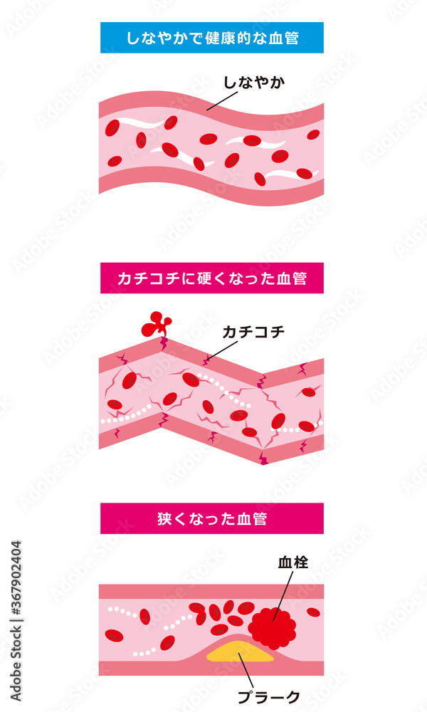動脈硬化の血管のイラスト – 動脈硬化 画像 フリー – ITXKRQ
