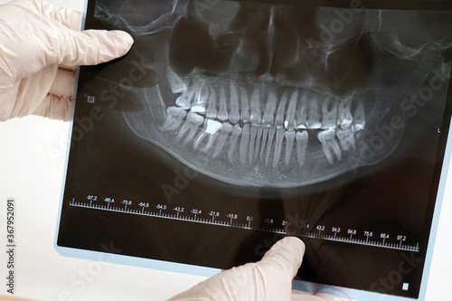 CT scan of teeth in the hands of a doctor with gloves