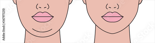 Double chin, restoration of facial contours with aid liposuction