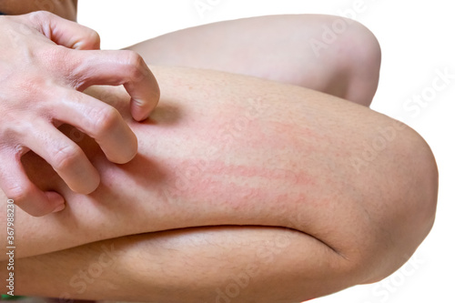Young women develop rash on the legs Allergy symptoms He uses his hands to scratch the rash. on White background and clipping path.